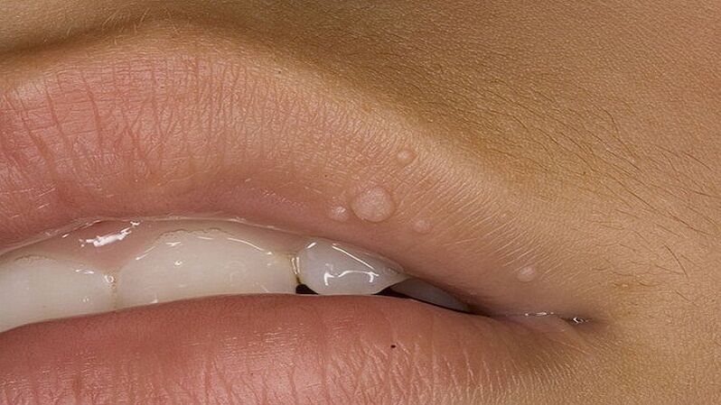 Papilloma on the lips