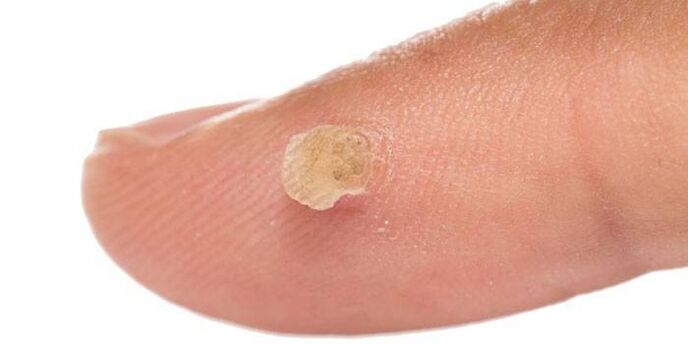How to treat a wart on the finger