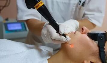 Effective way to remove facial papilloma with laser