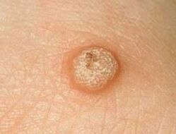 common warts on the skin