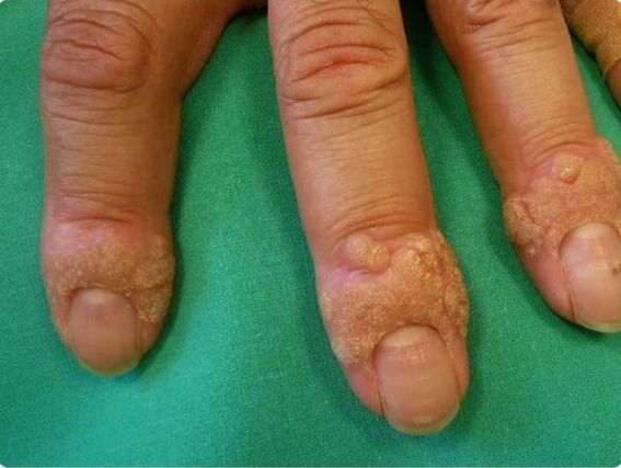 How to get rid of warts on fingers
