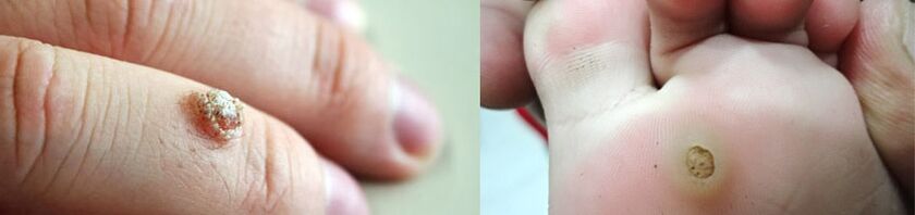 Finger and plantar warts