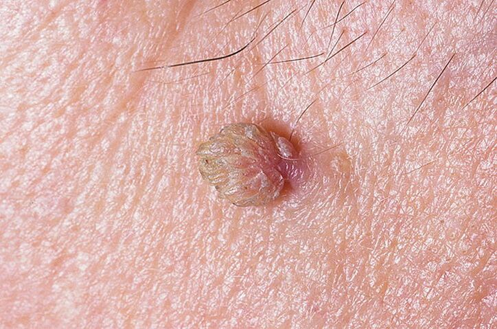 Warts on the skin can be removed in a variety of ways
