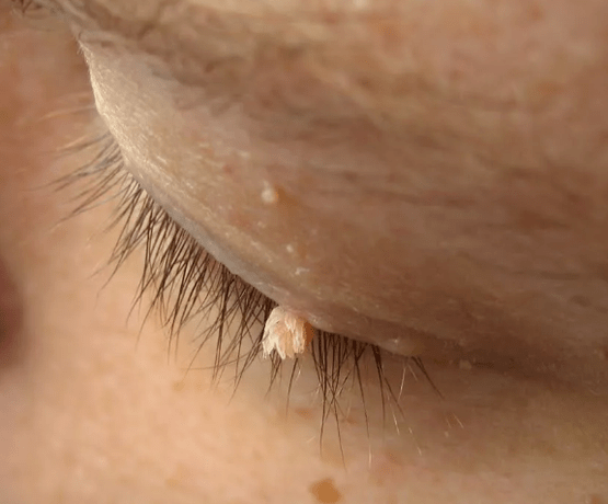 Movie papilloma