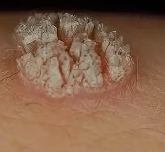 Simple papilloma
