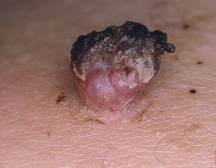 Black papilloma