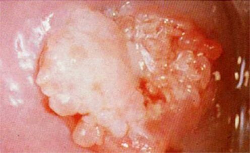 Candoid of the cervix