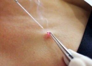 Laser removal