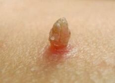 Sharp papilloma