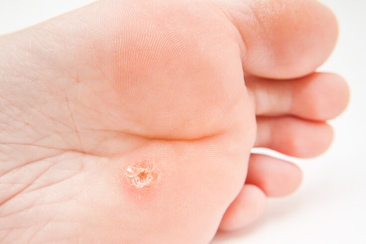 The only wart