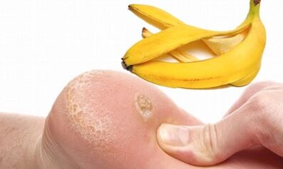 Banana peel for treatment of sole warts