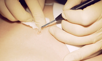 Surgery to remove sole warts
