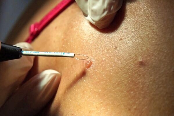 Using radio wave method to remove papillomas