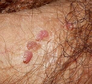 papilloma on penis