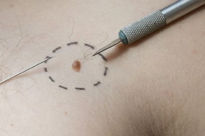How to remove warts