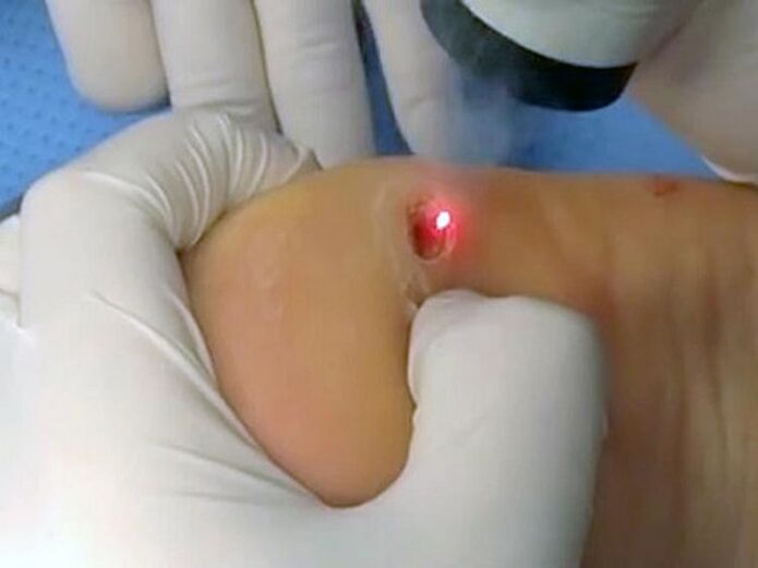 Laser treatment for warts
