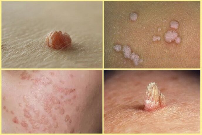 Types of warts