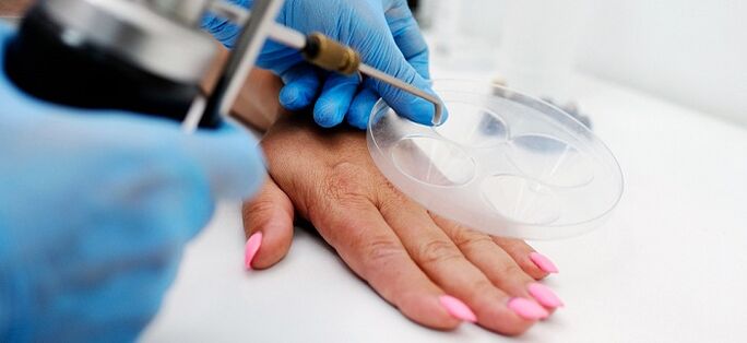 warts on human body