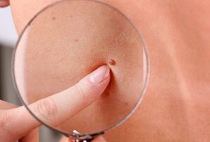 Causes of papilloma in human body