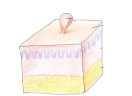 How to get rid of papillomas on your body