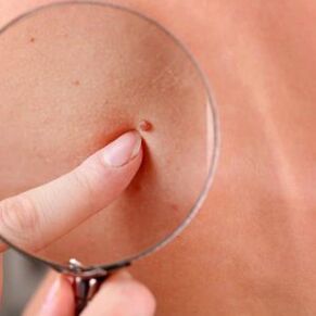 Can papillomas be removed