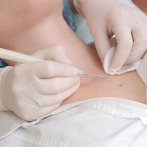 Treatment of male papilloma
