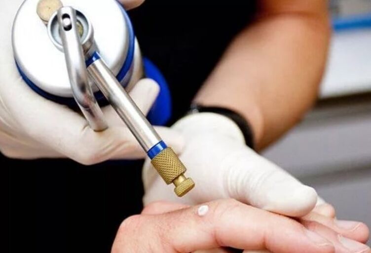 How to treat papillomas