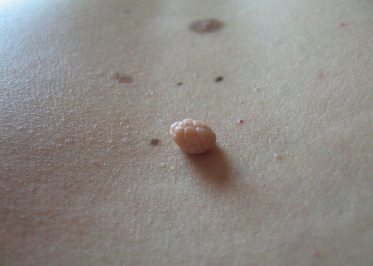 human papilloma
