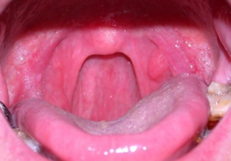 papilloma in throat