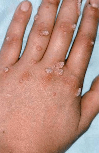 papillomas on hands