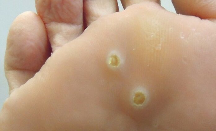 plantar papilloma