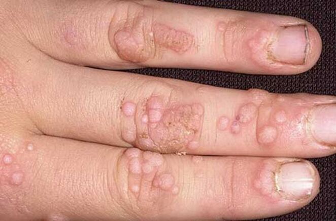 simple papilloma on arm