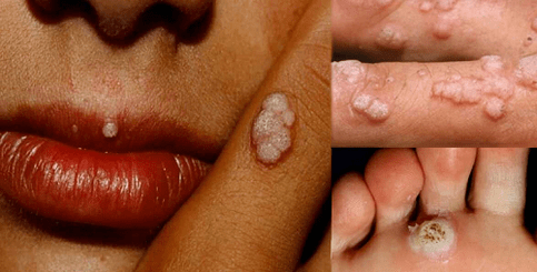 systemic papilloma