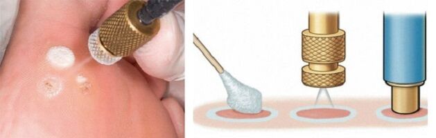 Cryodestruction as a method of papilloma removal