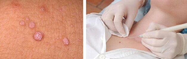 Professional Body Papilloma Removal
