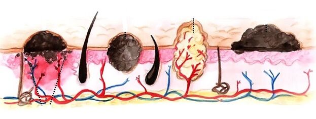 Types of human papillomas