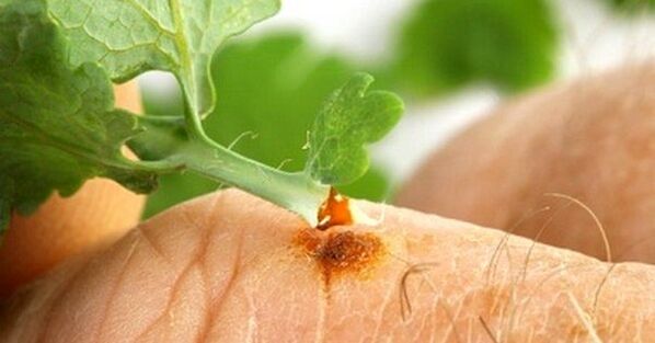 Chelidonium for Wart Treatment