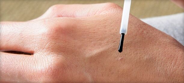 Treat warts with medicine