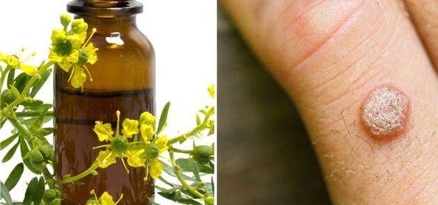 Treatment of warts with the drug celandine