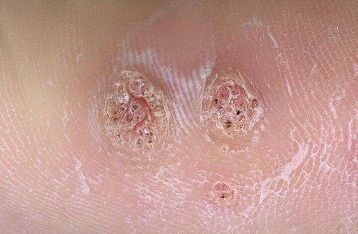 warts on body