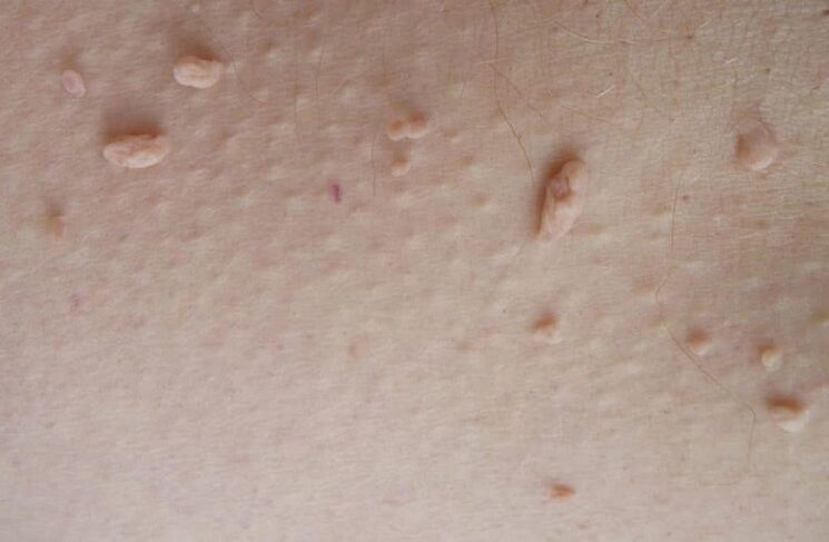 Cutaneous filiform papilloma