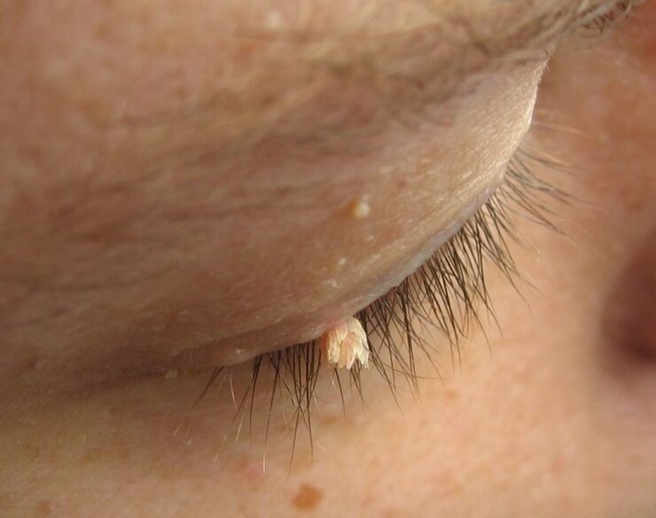 Genital warts on eyelids
