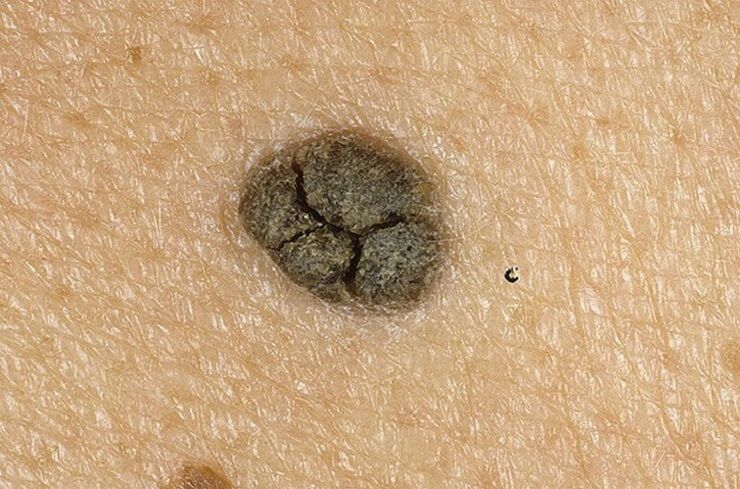 Keratoma on body skin
