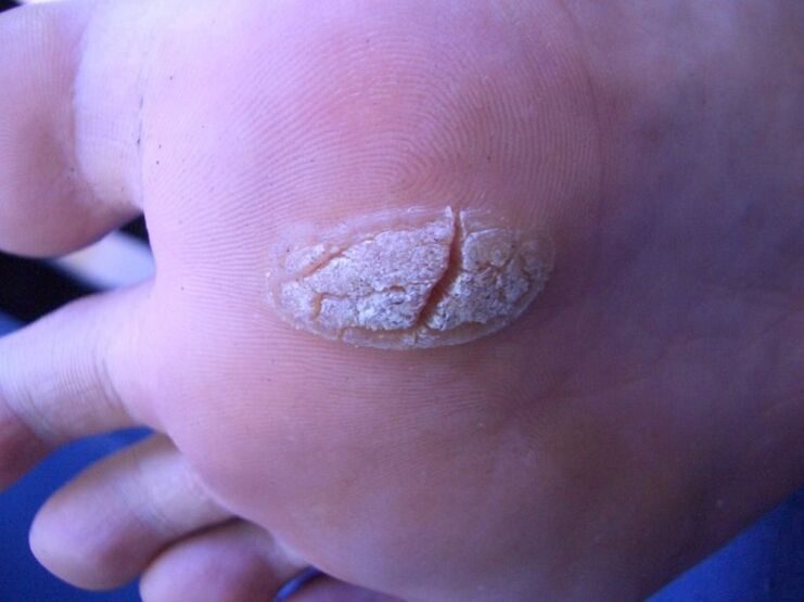 Warts on the skin of the feet