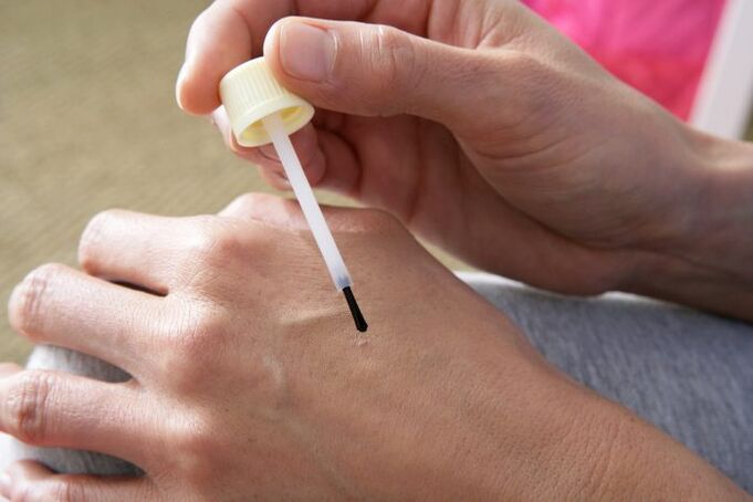 Celandine juice burns warts