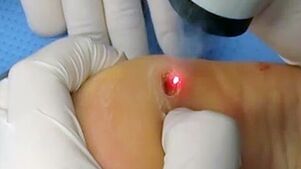 Laser removal of warts