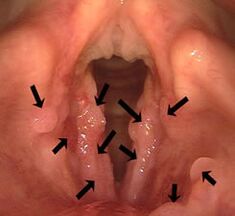 Papilloma of the larynx