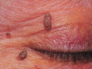 Papilloma on the eyelid