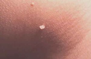 Skin papilloma