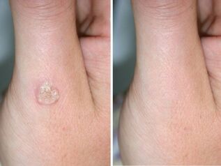 Remove the front and back warts